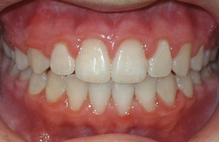 Cross Bite Before and After Dental Braces Pictures