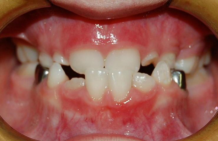 Cross Bite Before and After Dental Braces Photos