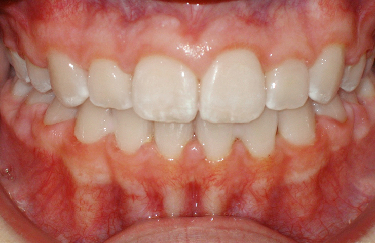 Cross Bite Before and After Orthodontic Care Photos