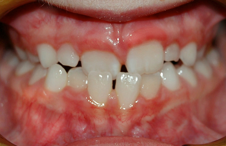 Cross Bite Before and After Orthodontic Care