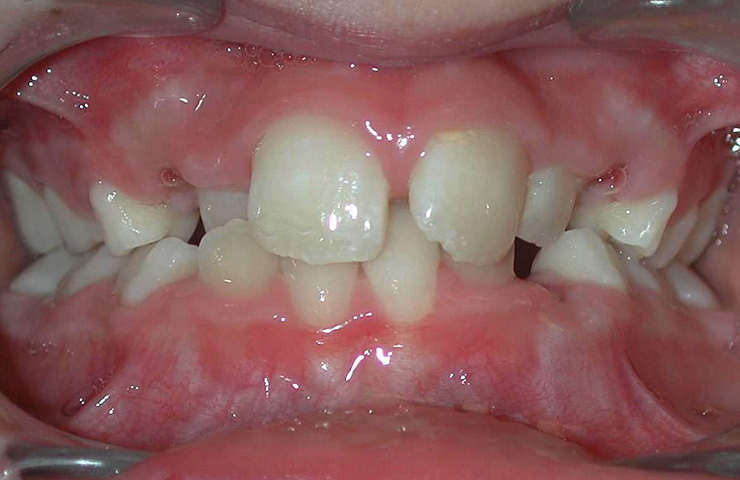 Cross Bite Before and After Orthodontic Care Pictures