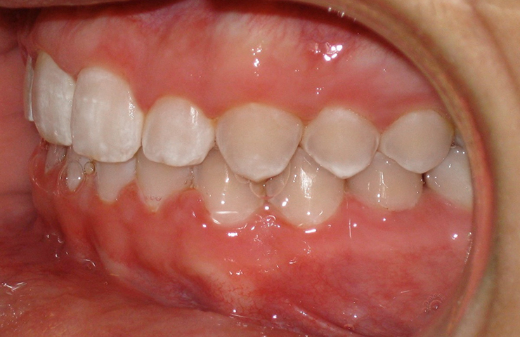 Cross Bite Before and After Orthodontic Treatment Pictures