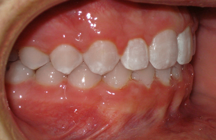 Cross Bite Before and After Orthodontic Treatment