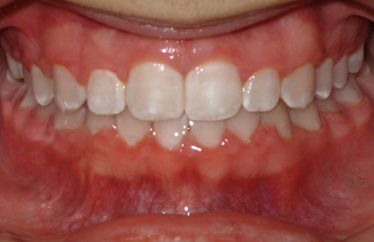 Cross Bite Before and After Orthodontic Treatment Photos