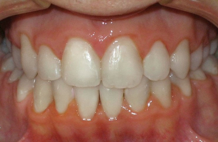 Crowding Before and After Straightening Teeth