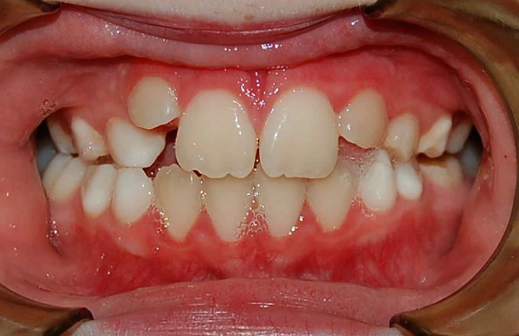 Crowding Before and After Straightening Teeth Photos