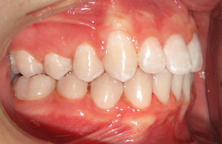 Crowding Before and After Invisible Braces