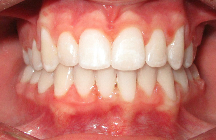 Crowding Before and After Invisible Braces Photos