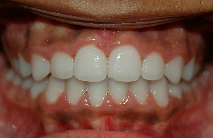 Crowded Teeth Before and After Straightening Teeth Photos