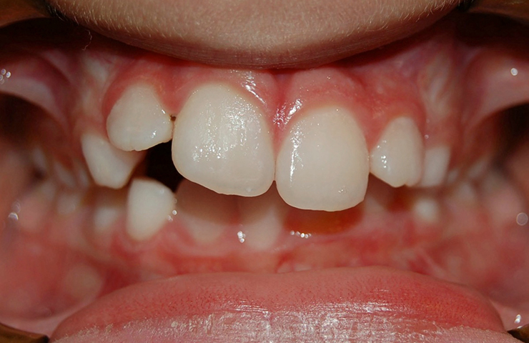Crowded Teeth Before and After Straightening Teeth Pictures