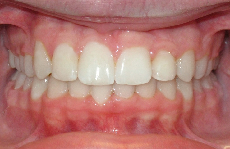 Crowded Teeth Before and After Braces Pictures