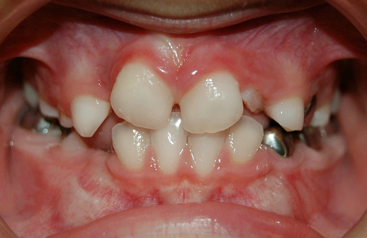 Crowded Teeth Before and After Invisalign