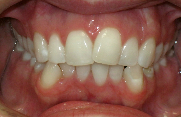 Crowded Teeth Before and After Invisalign Pictures