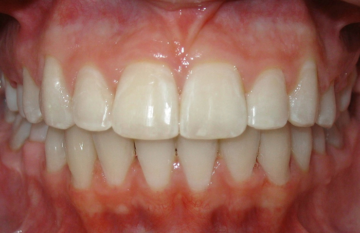 Deep Bite Before and After Orthodontic Treatment Photos