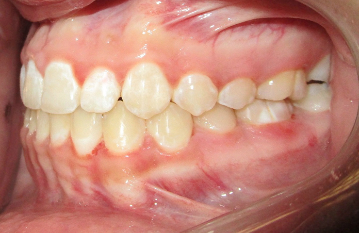 Deep Bite Before and After Straightening Teeth Pictures