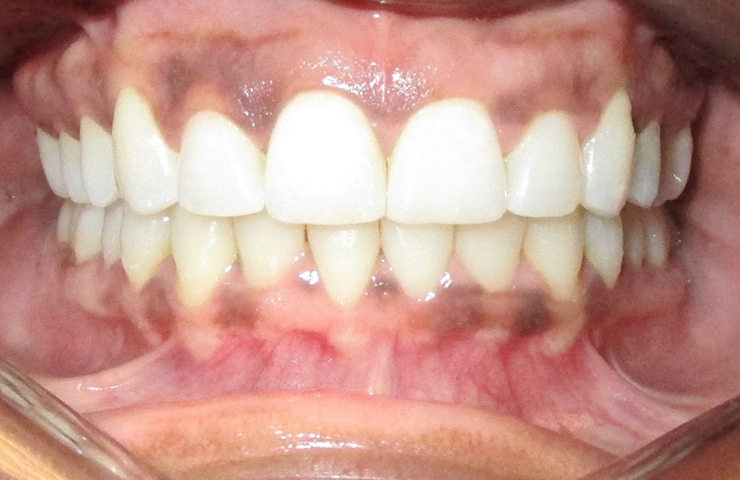 Clear Braces Before and After