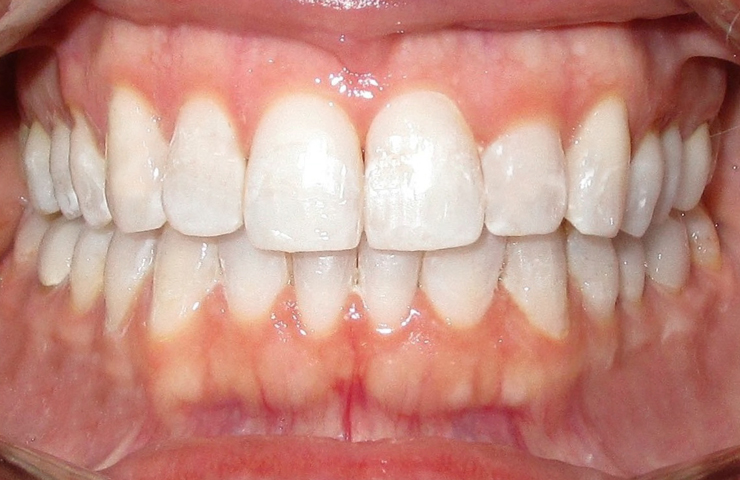 Invisalign Smiles Before and After