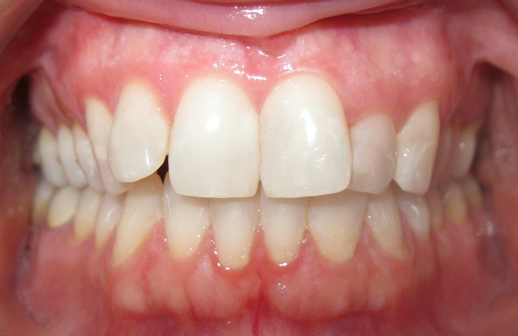 Clear Braces Before and After Invisalign Pictures