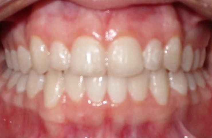 Invisalign Braces Before and After Pictures