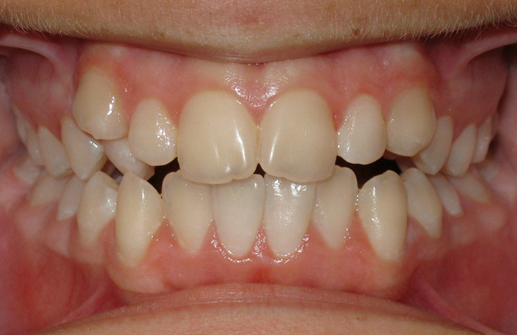 Invisalign Braces Before and After