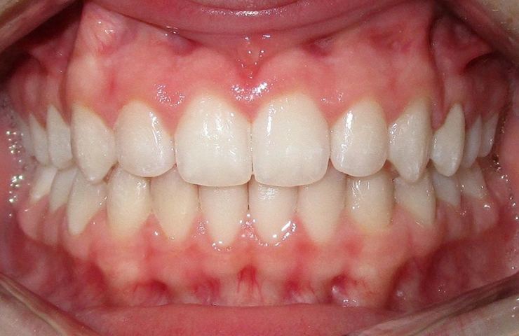 Invisalign Clear Braces Before and After Pictures