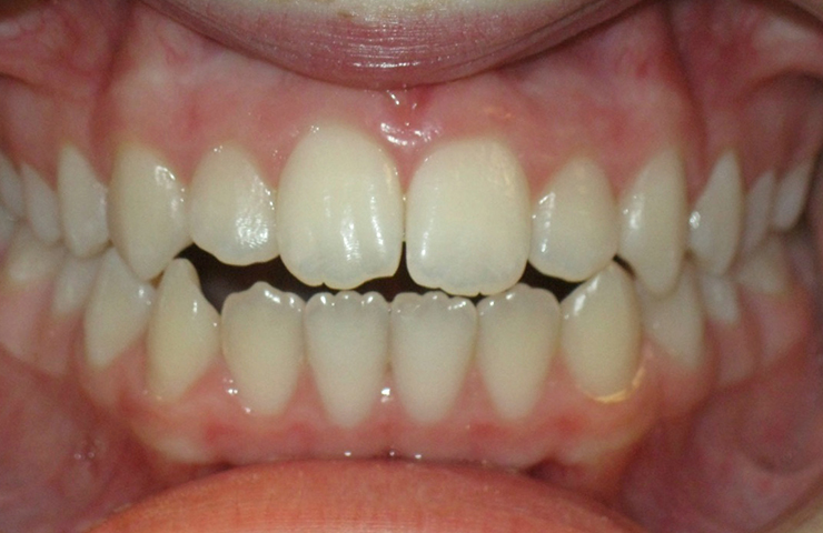 Invisalign Clear Braces Before and After