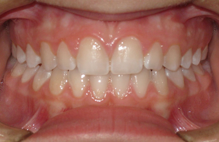 Open Bite Before and After Braces