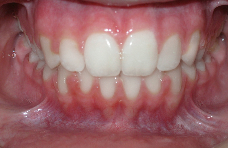 Teeth Protrusion - Braces Before and After Pictures