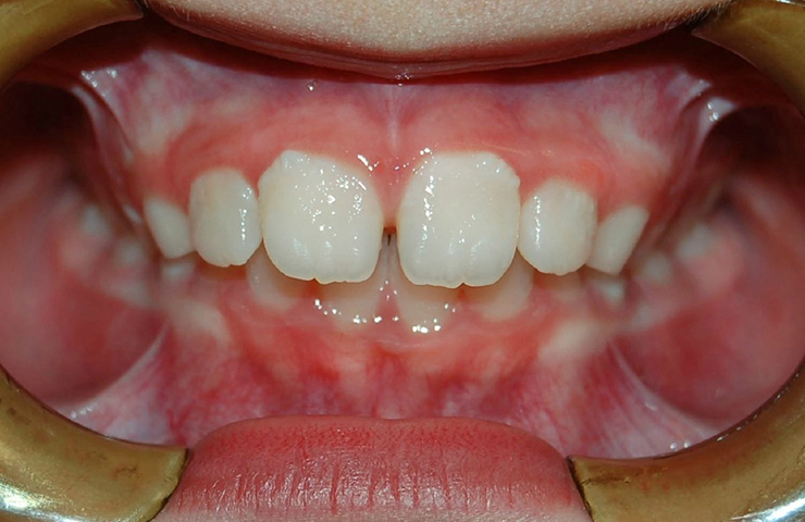 Teeth Protrusion Before and After Braces