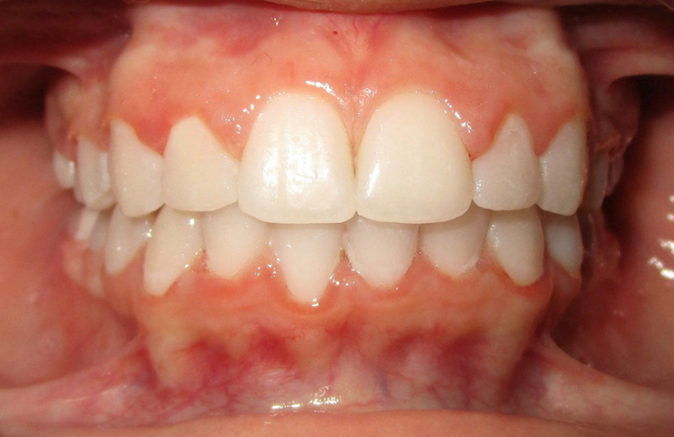 Protrusion Before and After Orthodontic Treatment