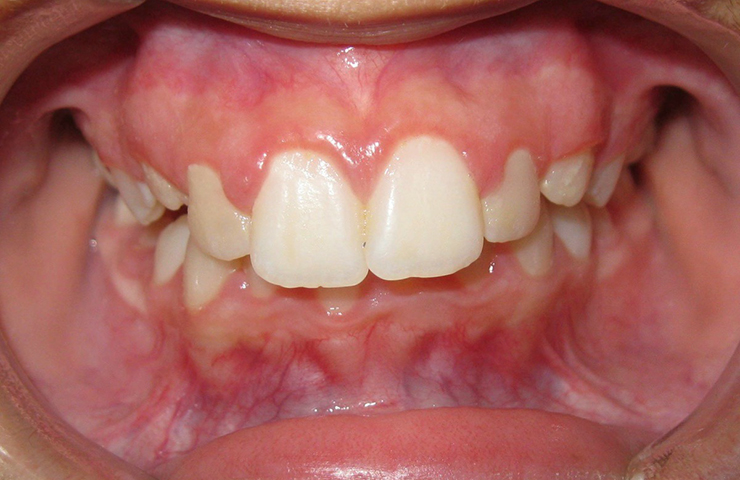Protrusion Before and After Braces Photos