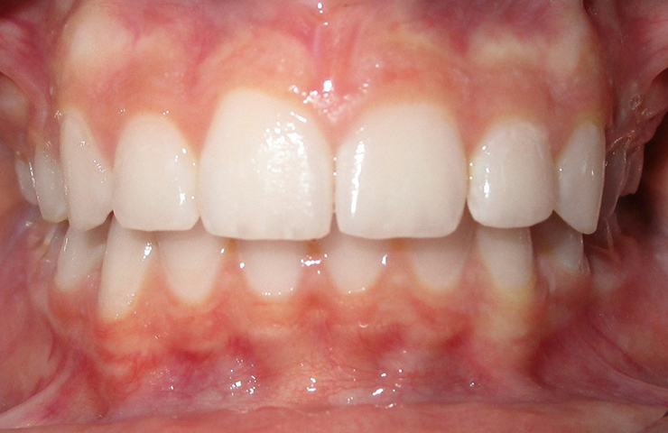 Protrusion Before and After Orthodontic Treatment Photos