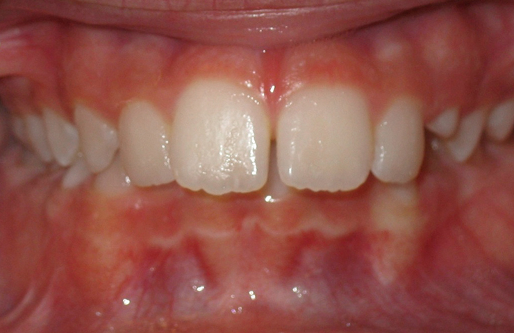 Protrusion Before and After Orthodontic Treatment Pictures