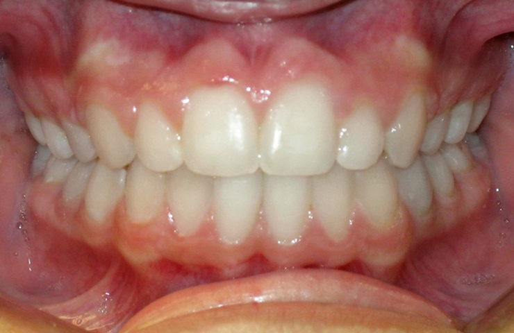 Protrusion Before and After Invisalign Pictures