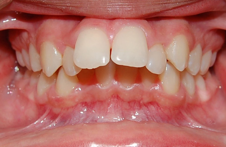 Protrusion Before and After Invisalign