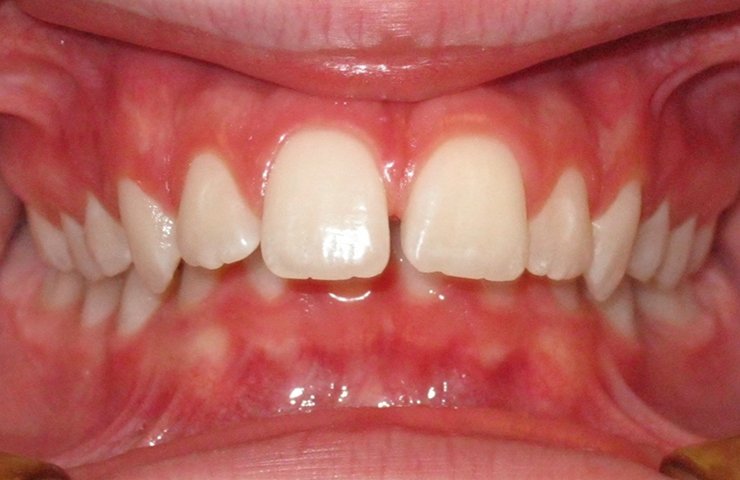 Protrusion Before and After Invisalign Photos
