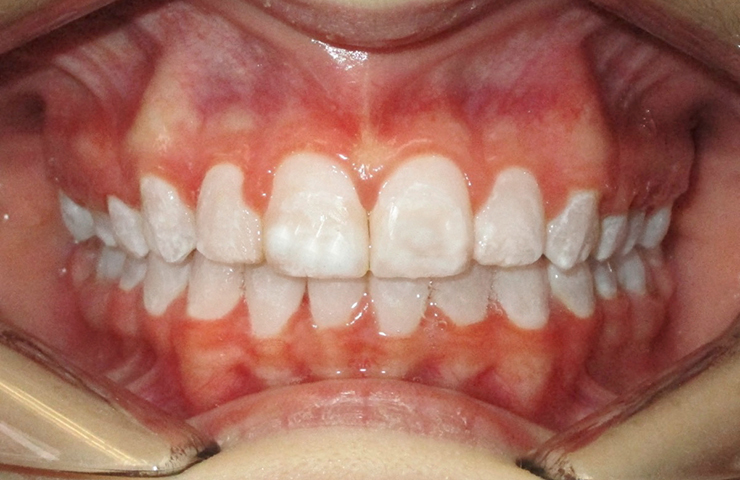 Protrusion Before and After Invisible Braces Pictures