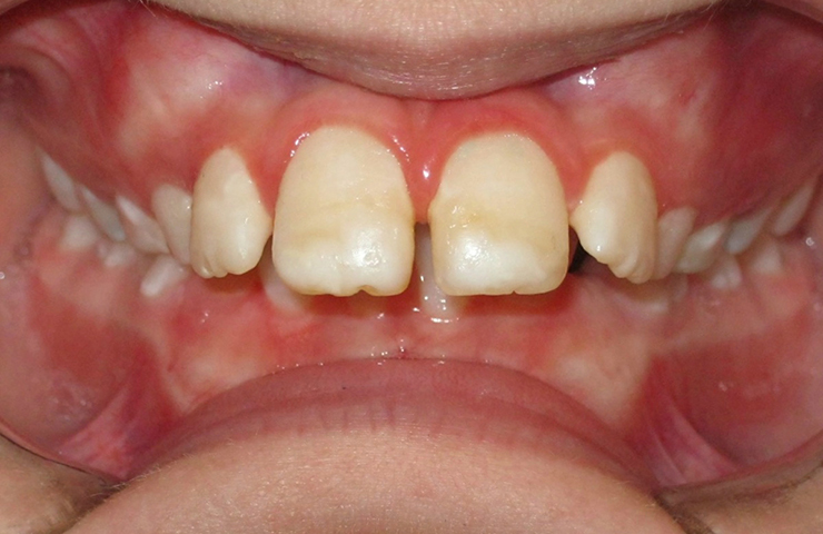 Protrusion Before and After Invisible Braces