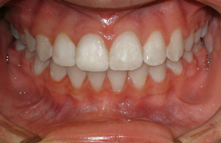 Spacing Before and After Orthodontic Treatment Pictures