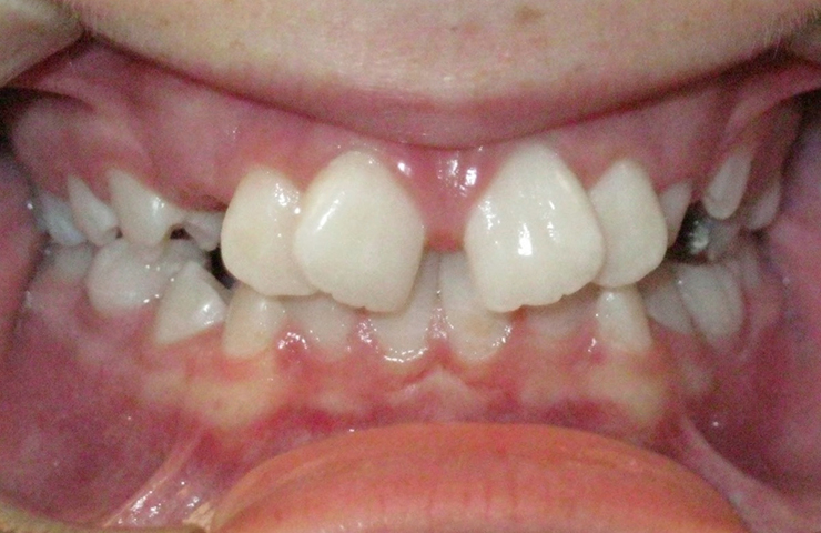 Spacing Before and After Orthodontic Treatment