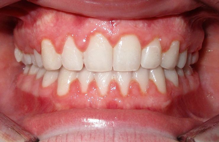Spacing Before and After Invisalign Photos
