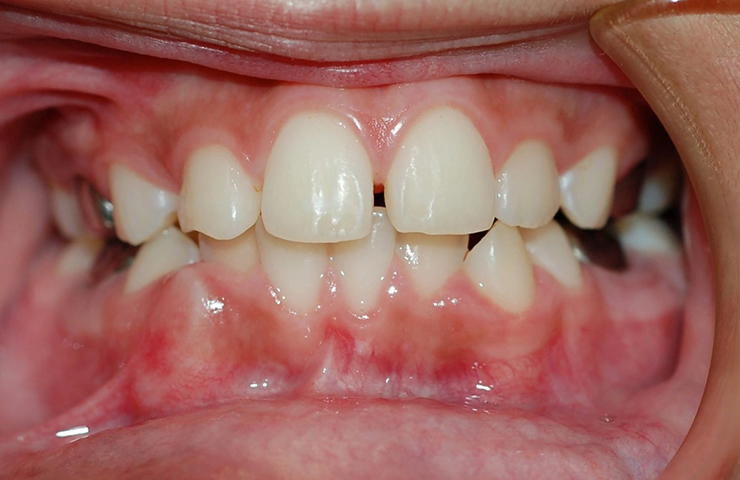 Spaces Between Teeth Before and After Braces Photos