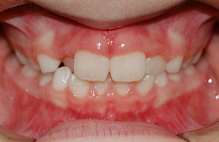 Cross Bite Before and After Invisible Braces