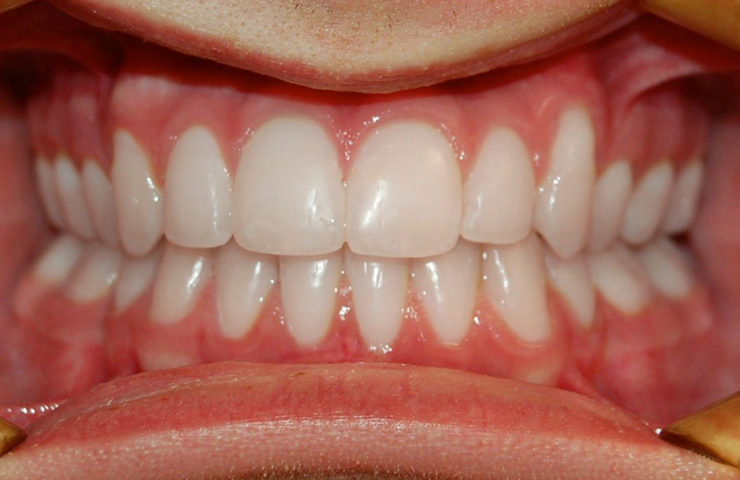 cross-bite-jh2-after