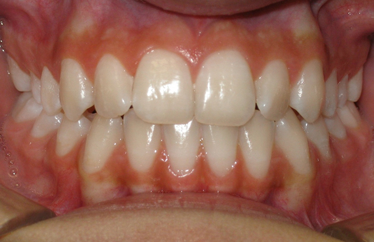 cross-bite-ms-after