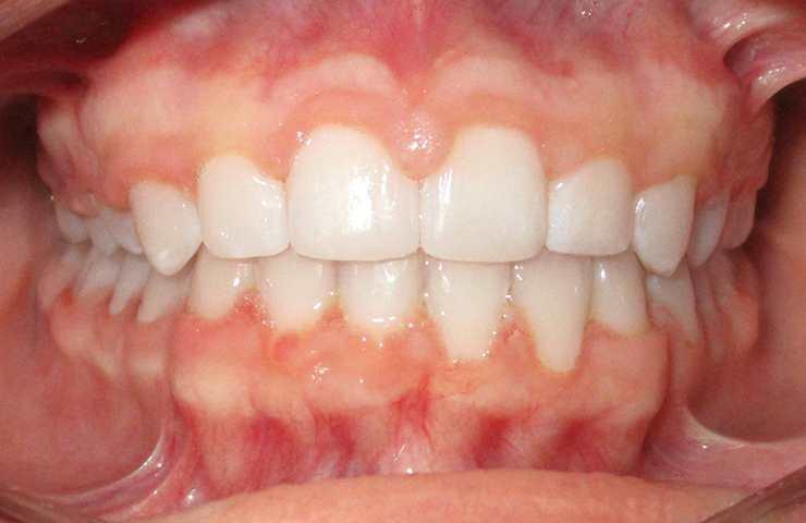 Cross Bite Before and After invisalign