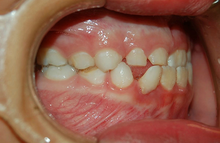 Cross Bite Before and After Treatment