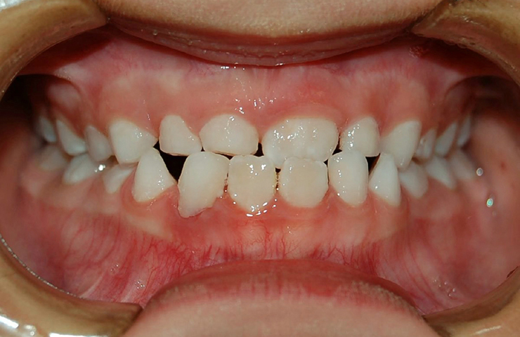 Cross Bite Before and After Treatment Photos
