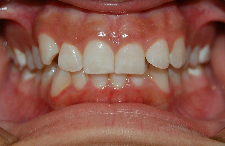 Crowding Before and After Invisalign