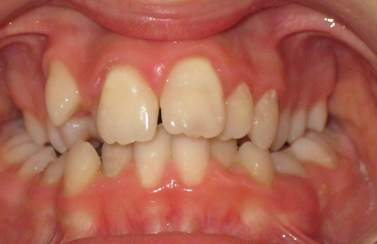 Crowding Before and After Invisalign Pictures